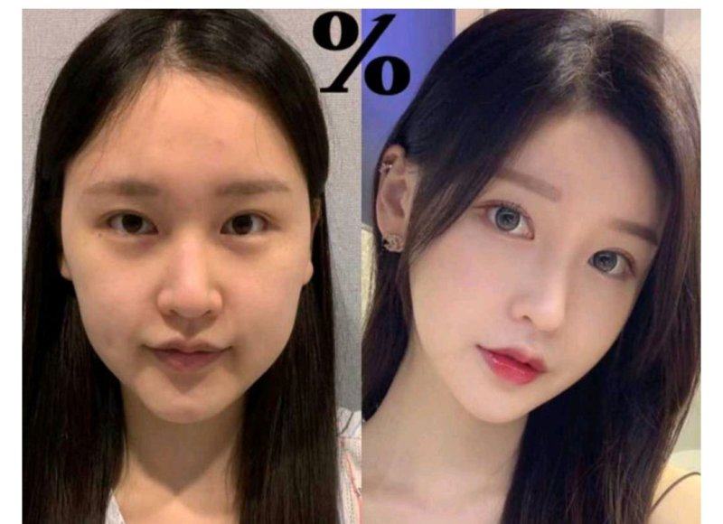 三、手臂吸脂一个月还没瘦/感觉还是特别粗怎么办?