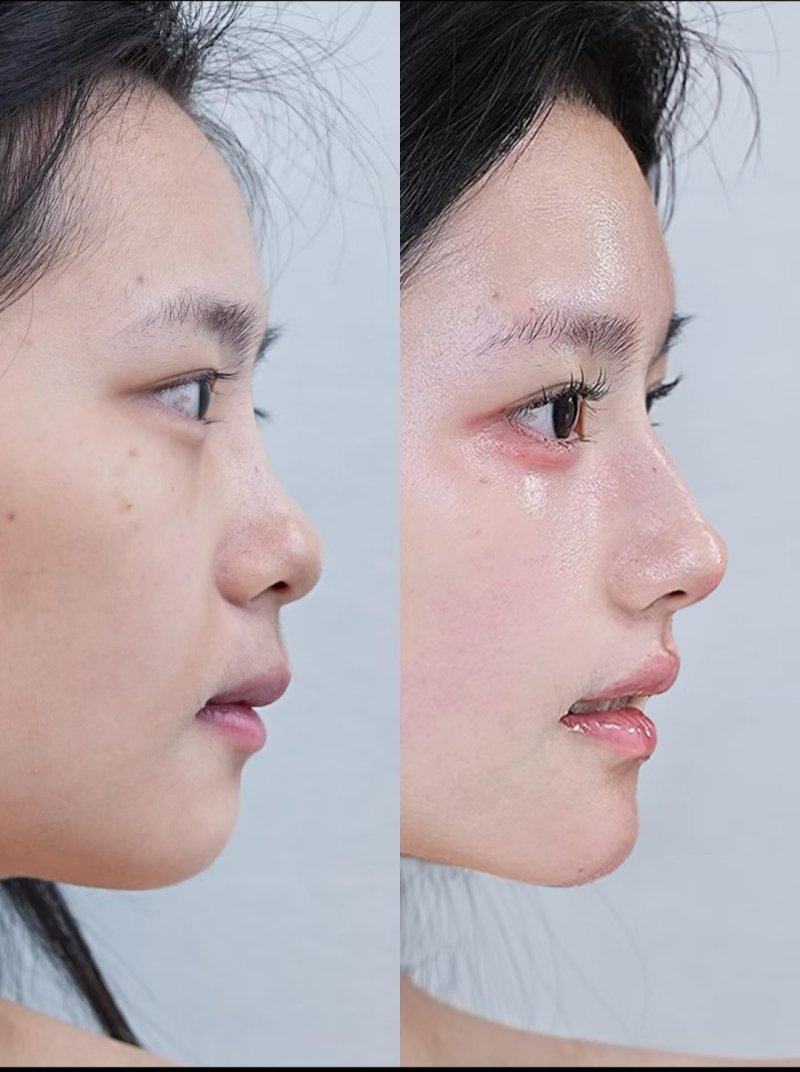 四、“有什么土办法去眼袋成效好”？别让无效方法耽误治疗时机