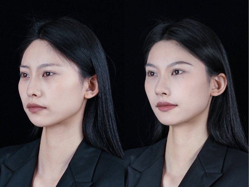 三、浅表性与色素沉着型疤痕的激光治疗方案