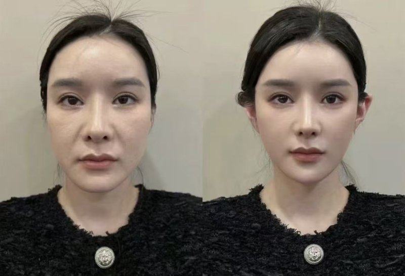 四、饮食与药物辅助：帮你更快褪去肿胀