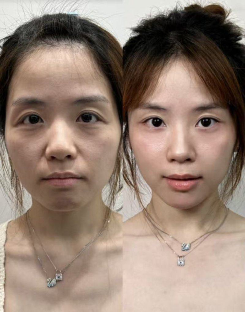 新手盲目尝试贴双眼皮贴的常见误区