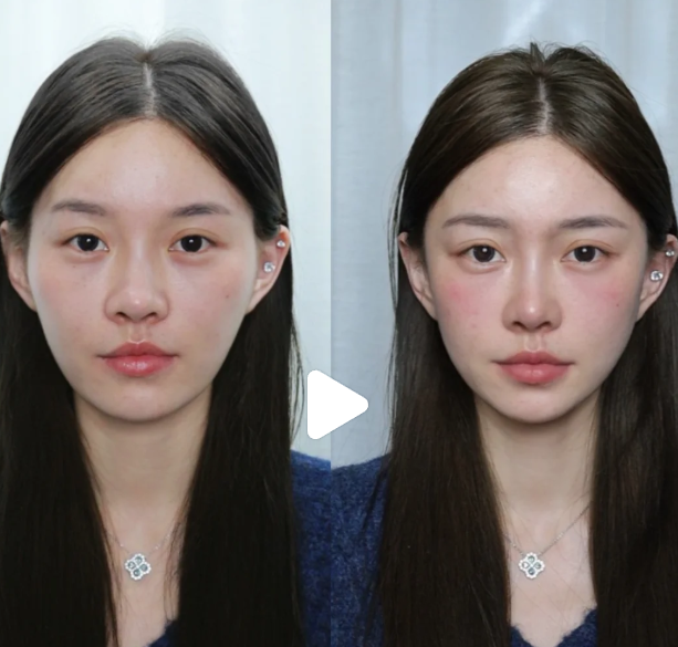 二、手臂吸脂一个月是不是已经定型了?