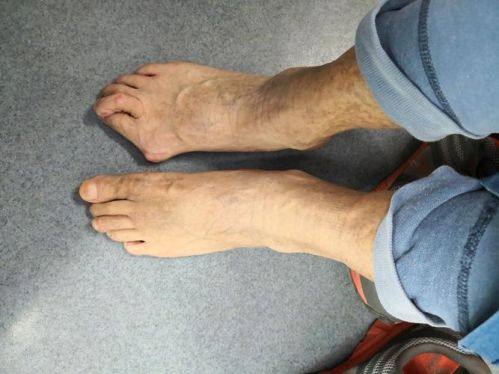 二、埋线双眼皮术后能吃酱油、酱油醋吗