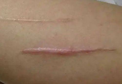 四、贴双眼皮眼睛痒怎么办缓解