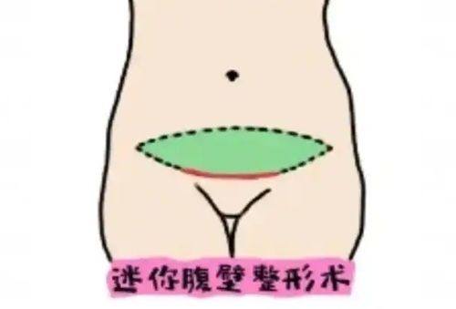 五、腹部手术疤痕与军事训练的关联及常见疑问解答