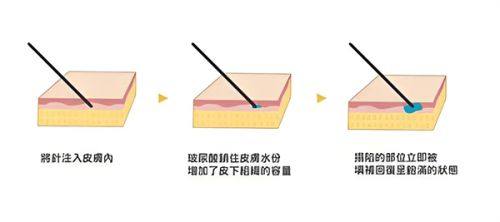 三、假体隆胸腋下疤痕增生的特殊成因