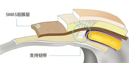 五、肿眼泡人群：埋线双眼皮不适合吸脂，全切是更优解