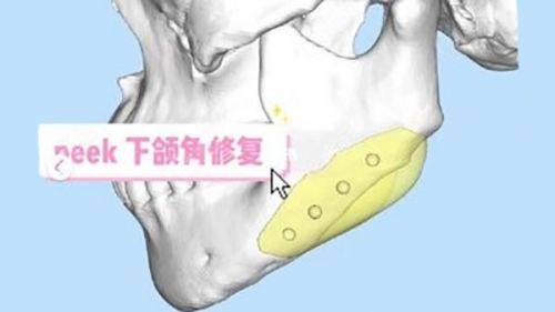 三、已形成的眼袋:医美方案是成效更直接的选择