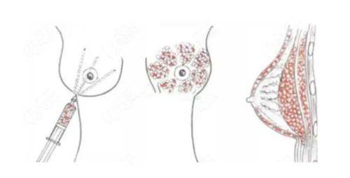 四、不同兵种对腹部手术疤痕的差异化要求