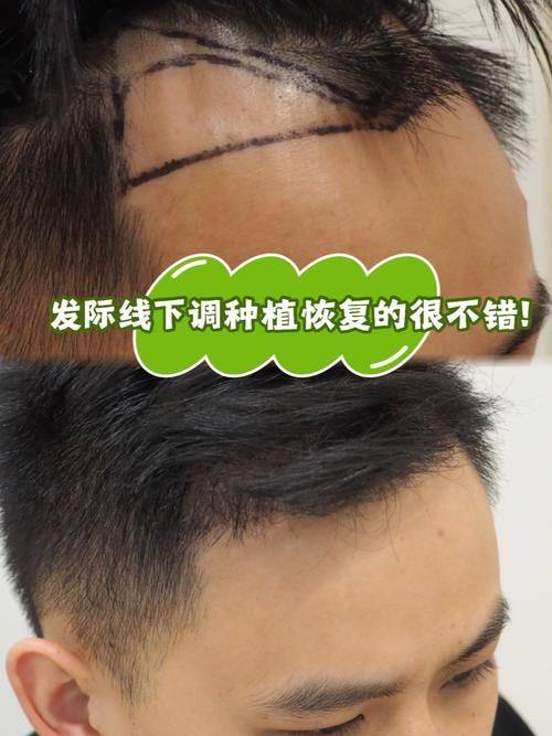 广东深圳青逸植发口碑评价