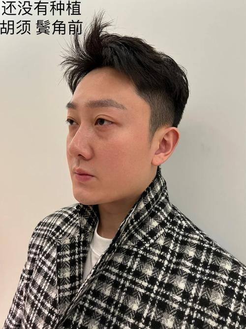 广东深圳青逸植发擅长项目：