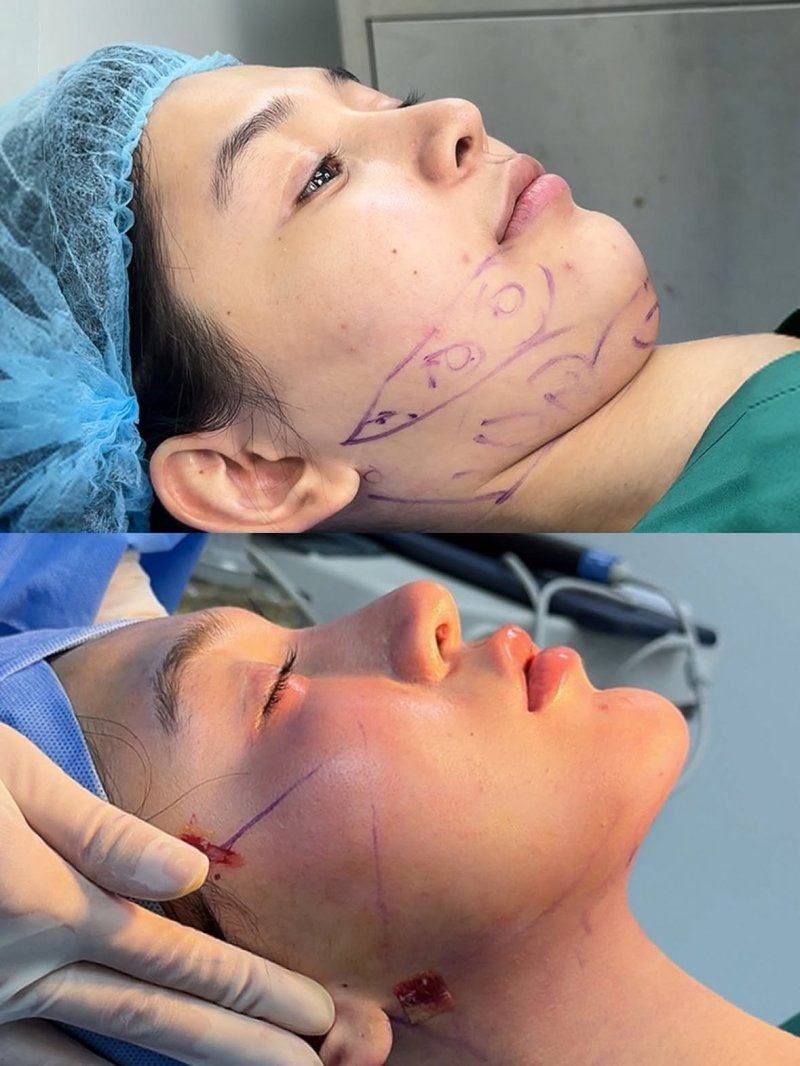 二、无需住院：微创技术与部分地区的便捷选择