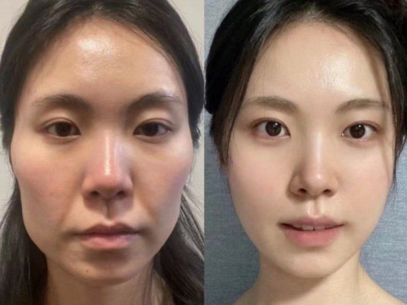 二、男兵腹部手术疤痕的征兵体检判定重点