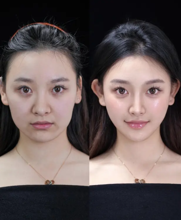 四、埋线双眼皮抽脂好吗？适配人群是关键