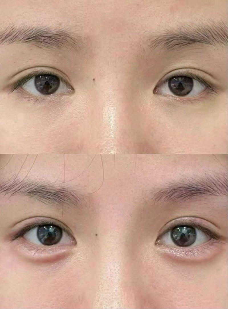 五、贴双眼皮眼睛痒怎么办小妙招