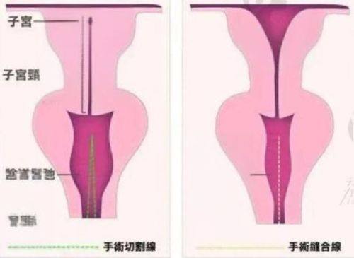 五、双眼皮手术失败的其他常见表现