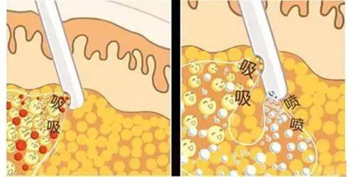 三、烫伤疤痕疙瘩治疗费用明细,提前做好预算规划