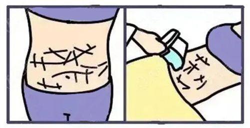 五、术后修复与其他关键注意事项