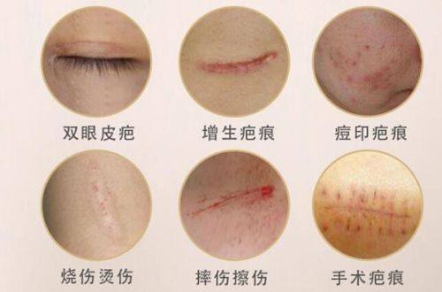 四、假体隆胸后多久可以干活?分场景看指引