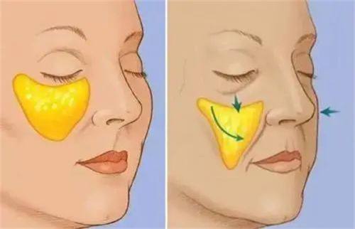 六、不同疤痕的针对性去除方法