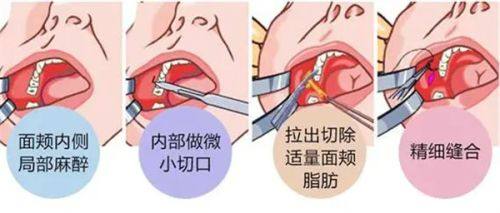 二、不同阶段开刀疤痕增生的护理与用药指南