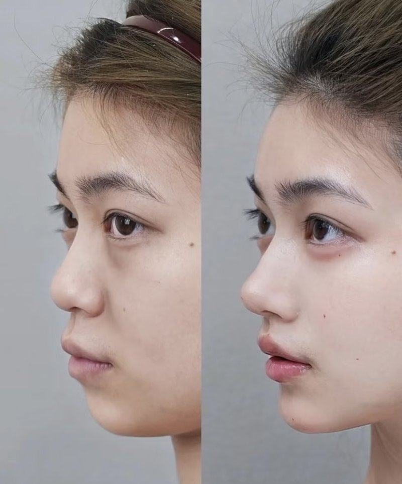 四、双眼皮伴随项目的潜在危害