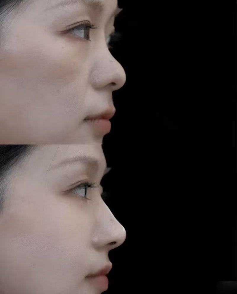 四、想要长期维持瘦脸成效,补针需要注意什么?