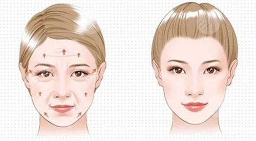 五、眼袋改善的关键注意事项