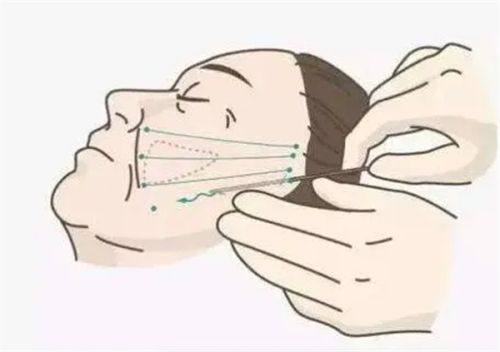 三、过度抽脂:被忽略的深层健康隐患