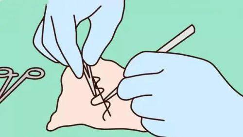 五、祛痣留下的疤痕能修复吗?不同疤痕的修复预期