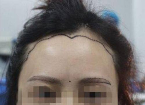 广州雍禾植发医生名单及擅长领域：