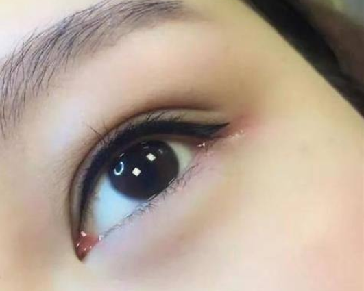 三、中重度眼袋的医美手术方案详解