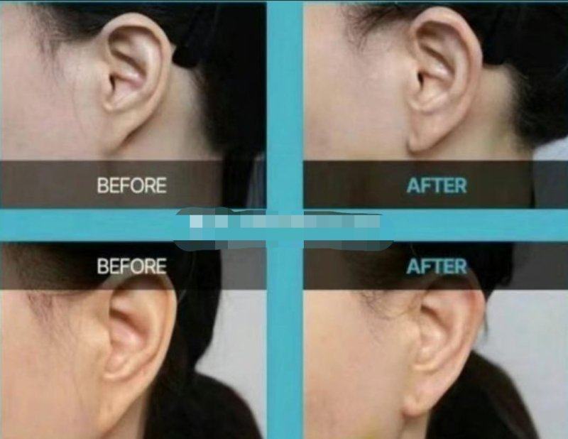 五、疤痕疙瘩用药的关键注意事项