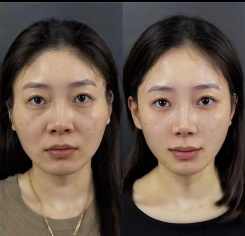 五、快速微创去下眼袋——聚能美雕与激光热熔术