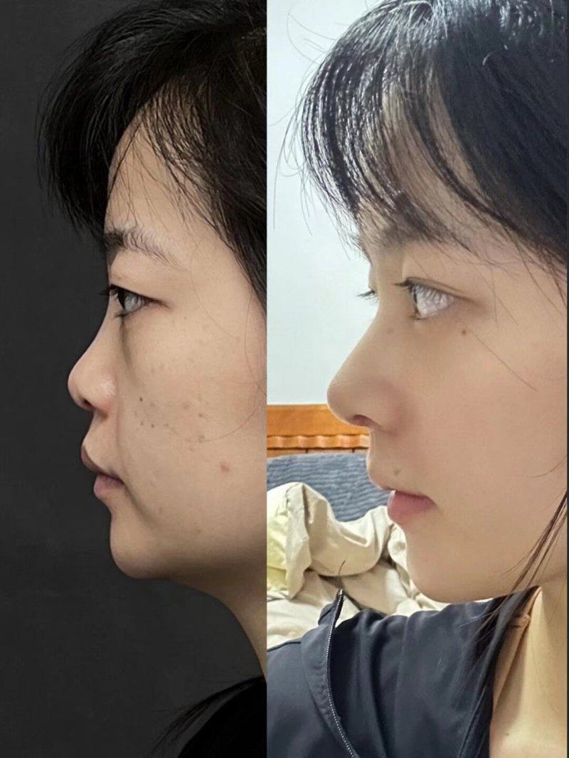 二、影响胶原蛋白隆鼻维持时长的关键因素