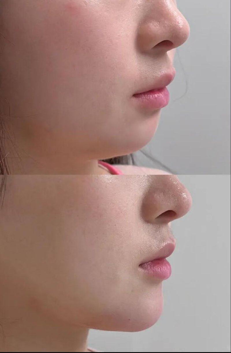 二、为什么祛痣后会留疤?揪出3大核心原因