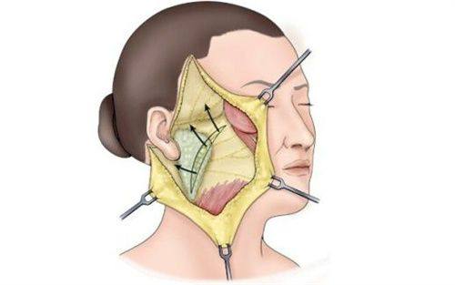 三、影响耳软骨隆鼻是否住院的核心因素