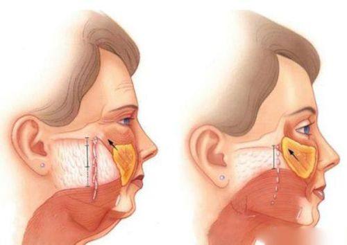 三、疤痕疙瘩怎么快速消除？选对方案是关键