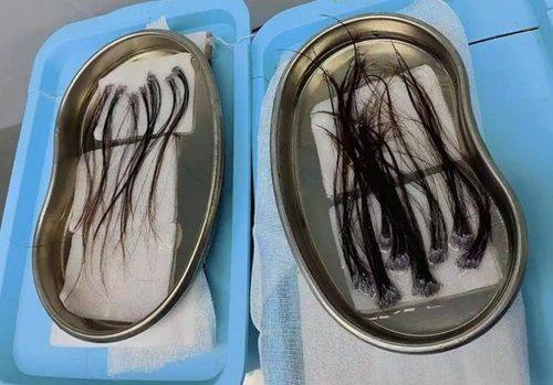 四、切痣的疤痕多久可以修复好