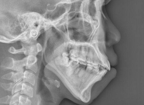 二、熊猫针修复:不同疤痕的改善周期