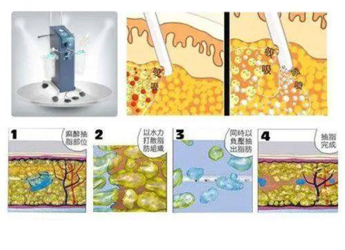 四、从根源规避眼袋手术后遗症的关键措施