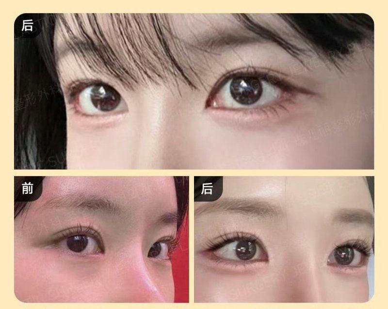 五、术后出现红肿疼痛,该怎么应急处理?