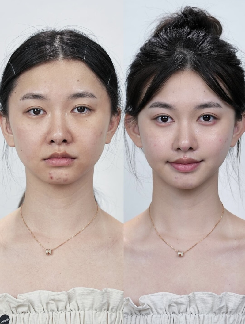 三、切痣的疤痕多久可以修复自然