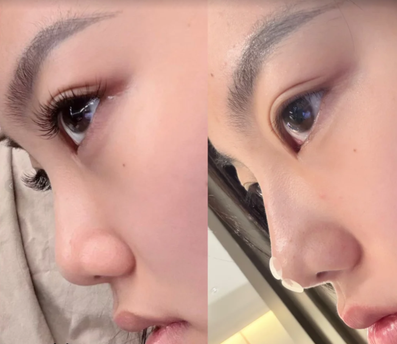 二、熬夜出的眼袋能睡回来吗?休息好能改善吗