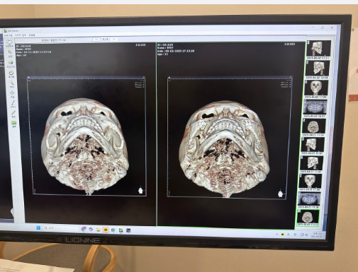 三、点阵激光修复:凹陷疤痕的长平周期