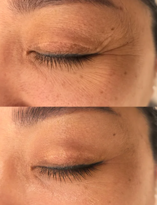 五、切除痣手术疤痕多长时间修复正常