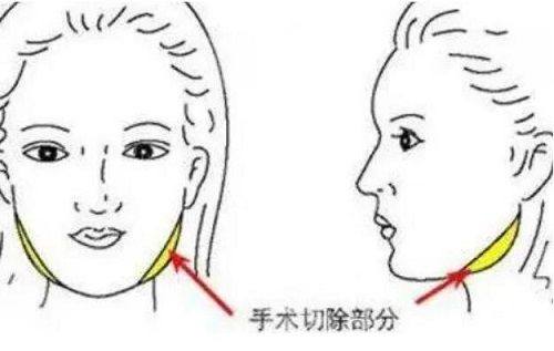 五、面部吸脂十年后的长期后遗症