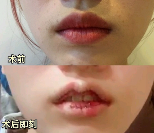 四、打瘦脸针术后的身体反应观察与应对