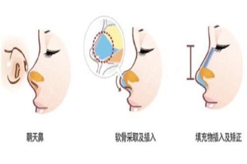 四、手术疤痕增生药膏的正确使用方法