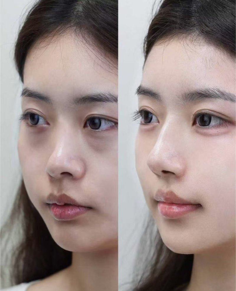 四、隆胸后可以上班吗?和家务修复节奏同步